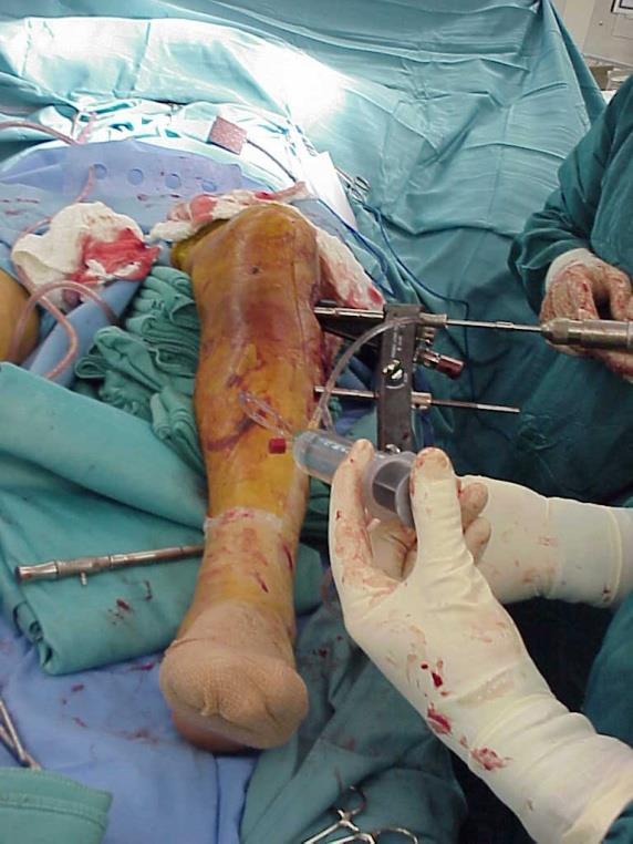 tibia