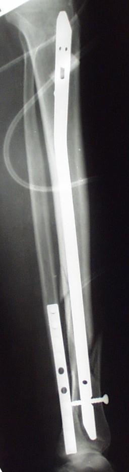 tibia törés: