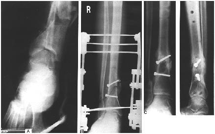 Supramalleolaris tibia