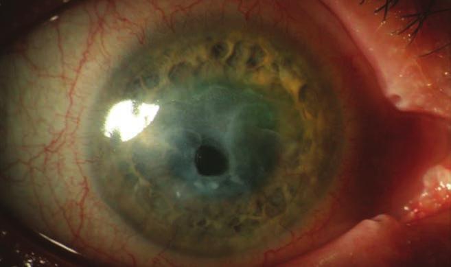 3. ábra: Ulceratív nekrotizáló keratitis (stromális keratitis) descemetokelével keratoplasztika előtt () és után () KEZELÉS Jelenlegi tudásunk szerint kombinált lokális vírusellenes (acyclovir 5 ) és