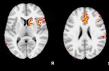 Fájdalomra aktiválódó agykérgi területek pain matrix (functional MRI studies) Primer érzőkéreg (SI) az érzőingerületek eredetének lokalizációja (topográfia) és kvalitásának felismerése.