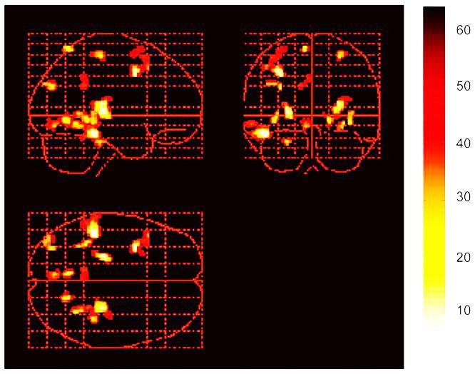 Centralis szenzitizáció (fmri