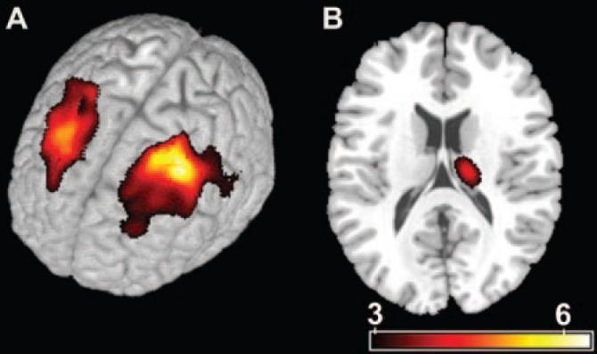 Idült fájdalom: neuroimaging (MR voxel based morphometria).