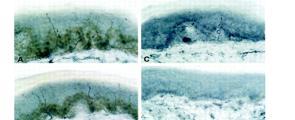 vékony rost ( small fiber ) neuropathia A szenzoros neuropathiák egyik kevésbé ismert altípusa a vékony rost ( small fiber ) neuropathia Aδ- és C-rostok szelektív diszfunkciója