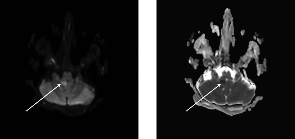 A kép: a B-módú felvételen az intima flap látható (fehér nyíl). B kép: a vastag fehér nyíl az AV transzducerhez közeli falára mutat.