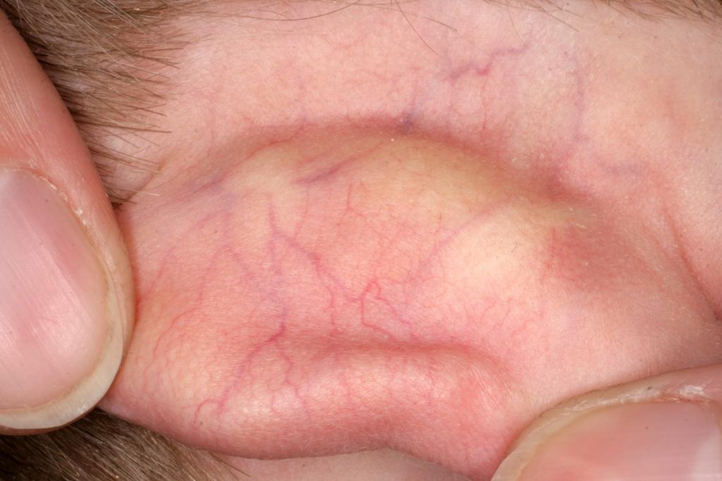 pityriasis lichenoides. Olyan esetekkel is találkozhatunk, amelyekben urticaria társult hozzá.