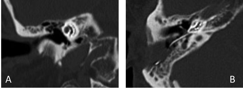 2. ábra Posztoperatív CT-felvételek. A) Koronális és B) axiális képeken látható a megfelelő helyzetben lévő elektróda CT = komputertomográfia és a hallószerv vérellátásának csökkenése SSNHL-t okozhat.