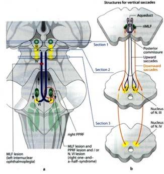 AGYTÖRZSben : OCULARIS AGYTÖRZSI STROKE Tünetei: Szemmozgató agyidegi