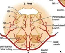 CAROTIS INTERNA): ACI atheroscleroticus