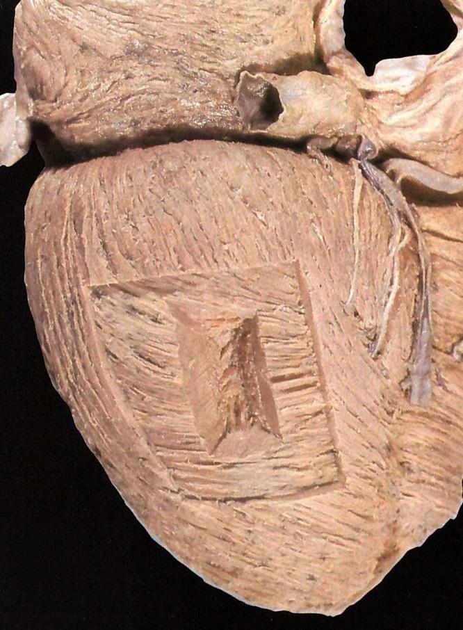 1 Ventricularis myocardium 2