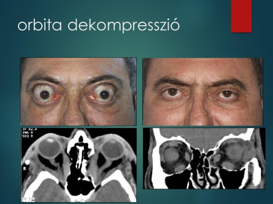 Ha a szteroid kezelés nem hat, vagy a megjavult látásélesség ismét visszaromlik, orbita dekompressziós műtétet kell