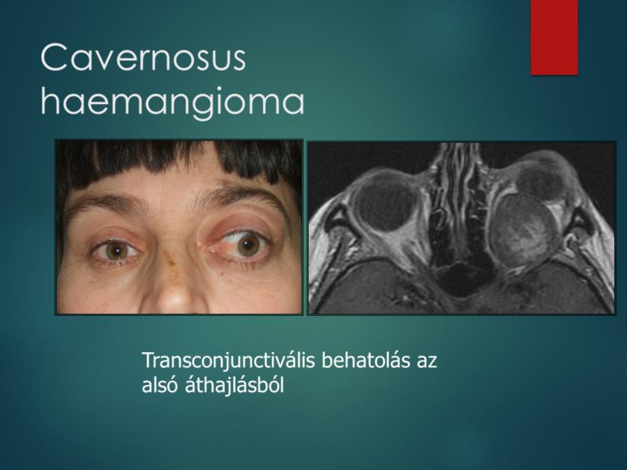 A leggyakoribb jóindulatú orbita tumor.