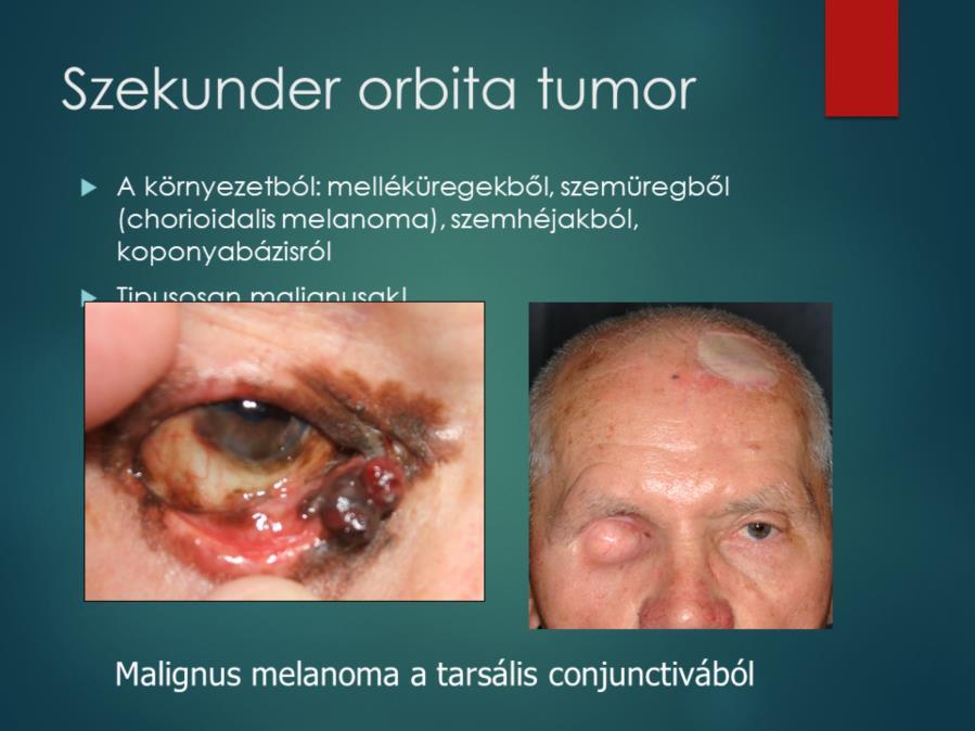 A kiterjedt tumor miatt exenterációt kellett végezni,
