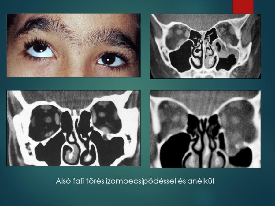 Az arcképhez a bal alsó CT kép tartozik: trap-door törés izombecsípődéssel.