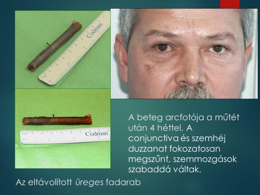 Az üreges fadarab magyarázza, CT képen ábrázolódott hypodens, levegőnek megfelelő denzitású