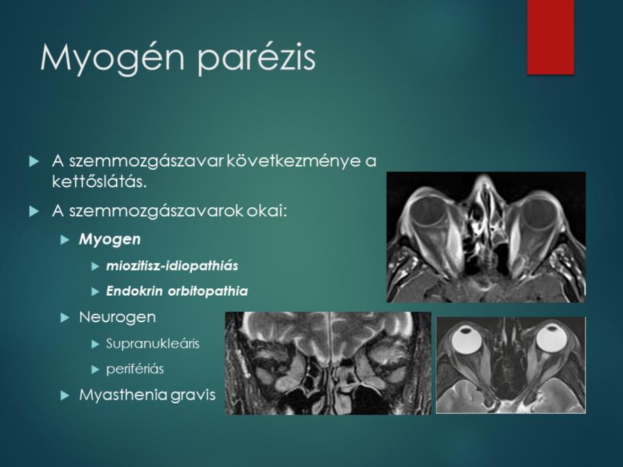 Neurogén, supranucleáris parézis esetén a két szem conjugált horizonzális ill, vertikális tekintése sérül. Perifériás neurogén parézis a szemmozgató idegek: n. trochleáris (n.iv), n.oculomotorius (n.