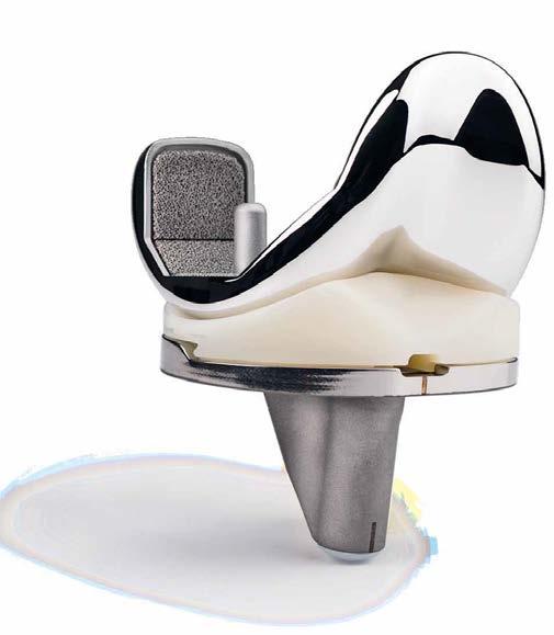 match 97% each patient s native A/P dimension Ideal tibial