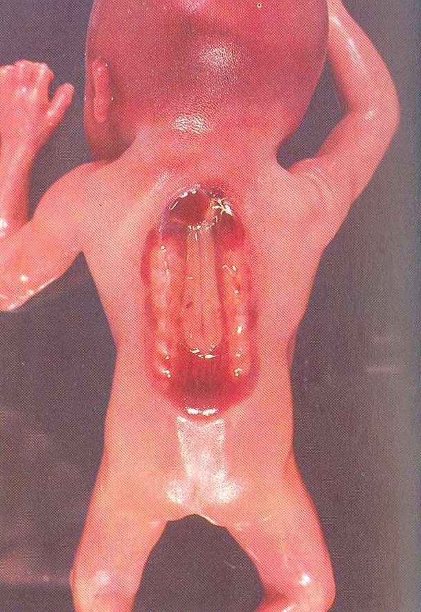 Rachischisis rachis = hát schisis = hasadék rachitis =