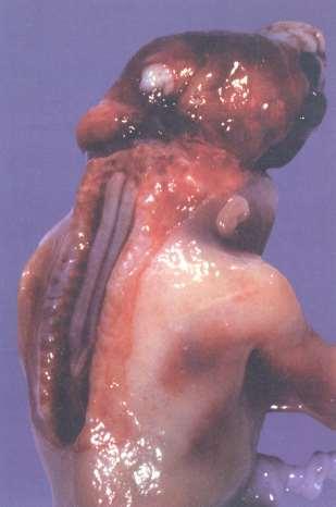 Rachischisis, inionschisis*,