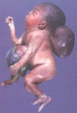 Exencephalia