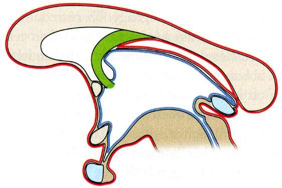 Commissurák és recessusok: ventriculus tertius fornix pia mater corpus callosum ependyma recessus suprapinealis commissura anterior ventriculus tertius