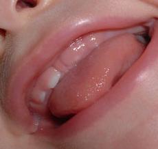 Philtrum és kifejezett TUBERCULUM