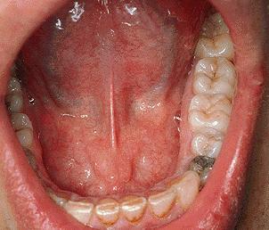 NYELVALATTI TÁJÉK Sulcus paralingualis Frenulum linguae Ductus submandibularis nyílása: Caruncula sublingualis Ductus