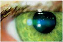 Keratoconus in the era of modern diagnostic tools and therapeutic possibilities 9.