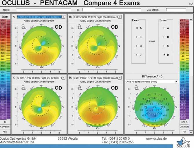 Keratoconus a modern diagnosztikus és terápiás lehetőségek korszakában 10.