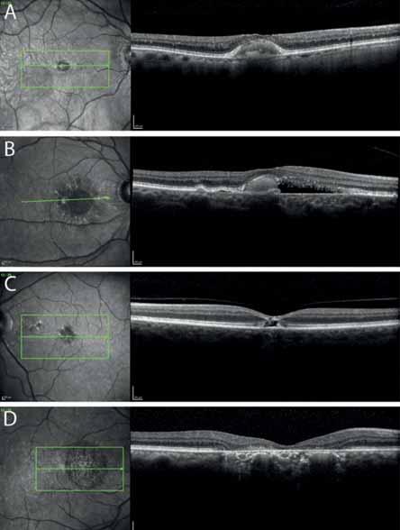 Retina pigment epithelium aperture Bevezetés A felnőttkori foveomacularis vitelliform disztrófia (AOFVD) a pattern disztrófiák (PD) csoportjába tartozik a butterfly-shaped pattern disztrófia, a