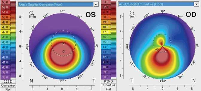 Keratoconus a modern diagnosztikus és terápiás lehetőségek korszakában 1.