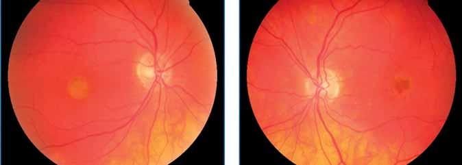 Retinapigment-epithelium apertúra 2.
