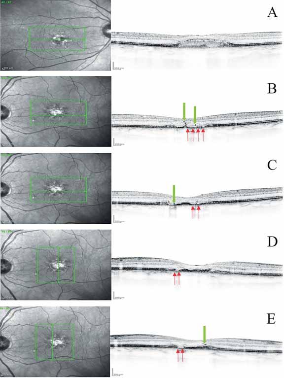 Retina pigment epithelium aperture 4. ábra: Infravörös szemfenéki felvételek, és makula OCT-felvételek Spectralis HRA + OCT-készülékkel készült infravörös szemfenéki, valamint makula OCT-felvételek.