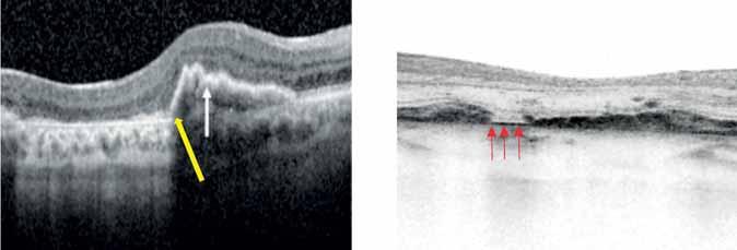 Retinapigment-epithelium apertúra 5.