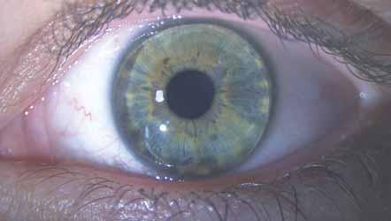 Efficacy of orthokeratology in different treatment groups Bevezetés A rövidlátók aránya az elmúlt évtizedekben világszerte többszörösére nőtt, a myopia egyre fiatalabb korban kezdődik és egyre
