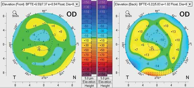 Keratoconus in the era of modern diagnostic tools and therapeutic possibilities 3.