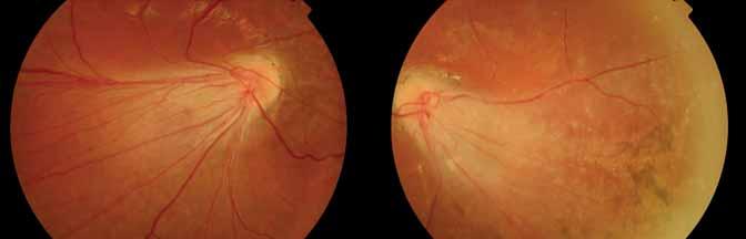 Koraszülöttek retinopathiája következtében kialakuló pseudostrabismus reflexet.