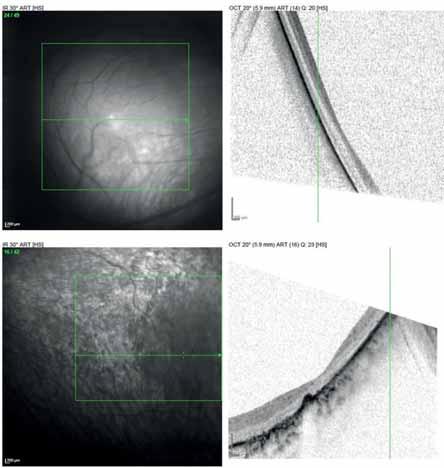 Pseudostrabismus secondary to retinopathy of prematurity 3-4 papillányi volt (kb. 5-6 mm), de pontosan kaliperrel nem volt mérhető, mivel a fovea nem volt egyértelműen detektálható.