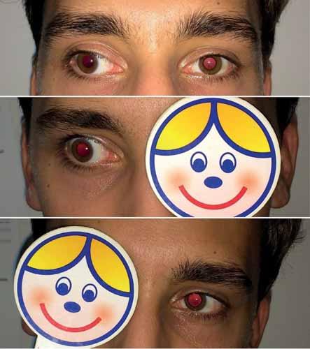 Koraszülöttek retinopathiája következtében kialakuló pseudostrabismus 3.