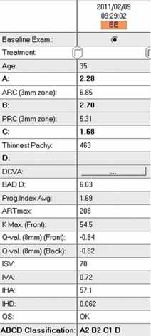 Keratoconus a modern diagnosztikus és terápiás lehetőségek korszakában 5. ábra: ABCD-klaszszifikáció toric ellipsoid [BFTE]) módban a ke ra toconus csúcsának magasságáról tájékozódhatunk.