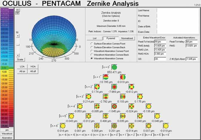 Keratoconus in the era of modern diagnostic tools and therapeutic possibilities 6.