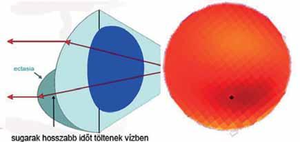 Keratoconus a modern diagnosztikus és terápiás lehetőségek korszakában 8.