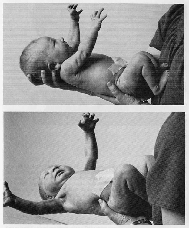 Moro-reflex Amikor a baba úgy érzi, hogy leesik Széttárja a karjait, ujjait kimereszti Lábával kirúg Lábak+karok ölelő pózban találkoznak össze Ha a baba egyik kezében már fog
