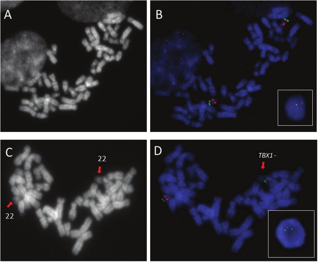2. ábra Fluoreszcens in situ hibridizáció (FISH) eredmények képei a 22q11.2-es régióban a TBX1-génre specifikus próbával, invazív beavatkozásból származó mintán. A) és B) 46,XX.ish 22q11.