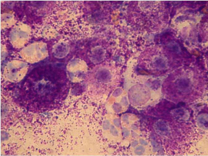 Granulocytosis eosinophilia: allergiás