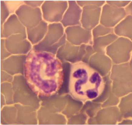 autoimmun reakciók (myositis eosinophilica,