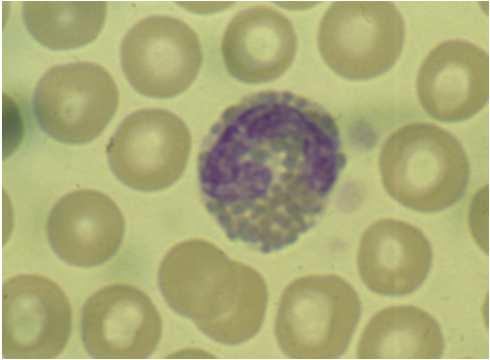 gastritis és enteritis), myeloid daganat,