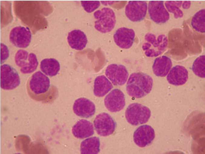 lymphoblastos leukémia (ALL)