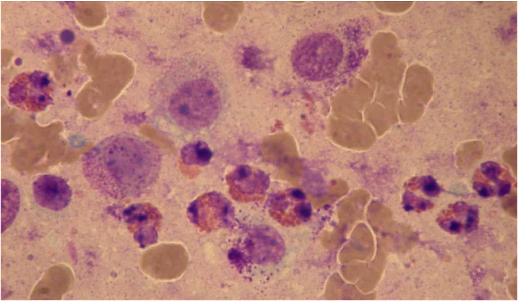 Eosinophil granulocyta: funkciója: phagocytosis (immmunglobulinokat), hisztamin