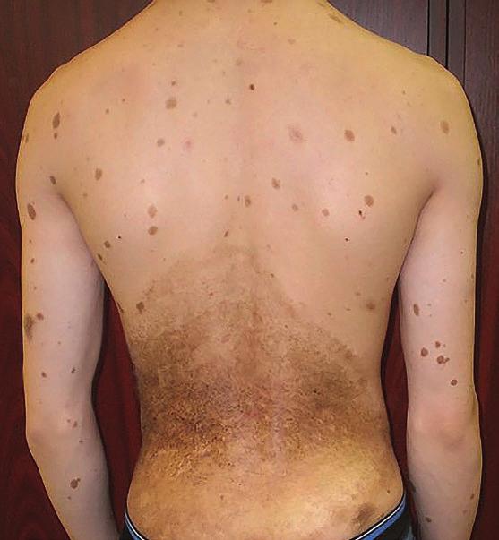 2023. 99.5. 356 364. 6. ábra CMN a törzsön kamaszkorban, újszülöttkorban végzett dermabrasio után tardív forma.